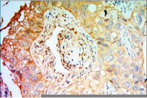 Immunohistochemical analysis of paraffin-embedded lung cancer tissues using PTK7 mouse mAb with DAB staining. (PTK7 抗体)