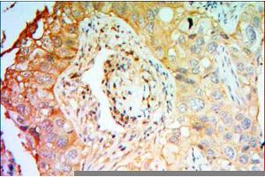 Immunohistochemical analysis of paraffin-embedded lung cancer tissues using PTK7 mouse mAb with DAB staining.