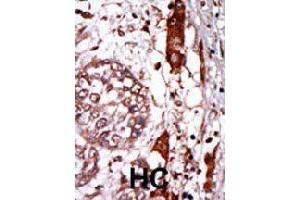 Formalin-fixed and paraffin-embedded human hepatocellular carcinoma tissue reacted with GNB2L1 polyclonal antibody  , which was peroxidase-conjugated to the secondary antibody, followed by AEC staining. (CDR2 抗体  (N-Term))