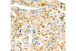 Immunohistochemistry of paraffin embedded human gastric cancer using MST1 (ABIN7075561) at dilution of 1: 1000 (400x lens) (STK4 抗体)