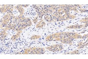 Detection of MAPK14 in Human Lung cancer Tissue using Polyclonal Antibody to Mitogen Activated Protein Kinase 14 (MAPK14) (MAPK14 抗体  (AA 19-279))