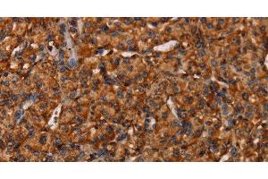 Immunohistochemistry of paraffin-embedded Human prostate cancer tissue using COL18A1 Polyclonal Antibody at dilution 1:40 (COL18A1 抗体)