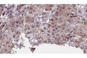 ABIN6277415 at 1/100 staining Human liver cancer tissue by IHC-P. (NFASC 抗体  (C-Term))