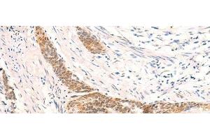 Immunohistochemistry of paraffin-embedded Human esophagus cancer tissue using HSPA4L Polyclonal Antibody at dilution of 1:30(x200) (HSPA4L 抗体)
