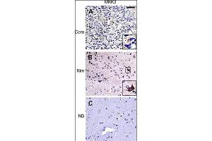 IHC of matched glioma core (top row) and rim (middle row) samples as well as normal brain control (bottom row) from a glioma invasion specific tissue microarray. (MAP2K3 抗体  (N-Term))