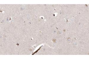ABIN6273003 at 1/100 staining Human brain cancer tissue by IHC-P. (L2HGDH 抗体  (Internal Region))
