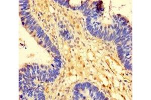 Immunohistochemistry of paraffin-embedded human ovarian cancer using ABIN7174393 at dilution of 1:100 (OTUB1 抗体  (AA 2-201))