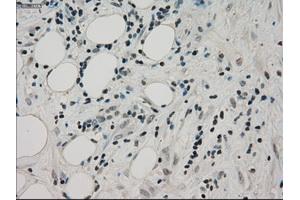 Immunohistochemical staining of paraffin-embedded Adenocarcinoma of colon tissue using anti-PPP1R7mouse monoclonal antibody. (PPP1R7 抗体)