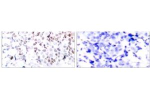 Immunohistochemical analysis of paraffin-embedded human breast carcinoma tissue using Myc (phospho- Thr358) antibody (E011035). (c-MYC 抗体  (pThr358))