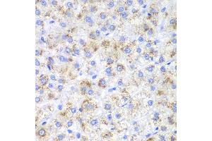Immunohistochemistry of paraffin-embedded human liver cancer using HAO1 antibody (ABIN5973868) at dilution of 1/200 (40x lens).