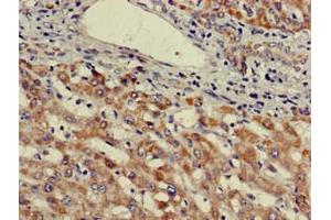 Immunohistochemistry of paraffin-embedded human liver cancer using ABIN7174571 at dilution of 1:100 (ube3a 抗体  (AA 83-234))