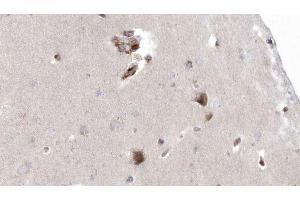 ABIN6272926 at 1/100 staining Human brain cancer tissue by IHC-P. (OXCT1 抗体  (Internal Region))