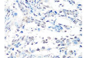 Immunohistochemistry of paraffin-embedded human lung cancer using MTA2 Antibody (ABIN5998268) at dilution of 1/100 (40x lens). (MTA2 抗体)