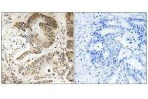 Immunohistochemistry analysis of paraffin-embedded human colon carcinoma tissue using PIK3R5 antibody. (PIK3R5 抗体)
