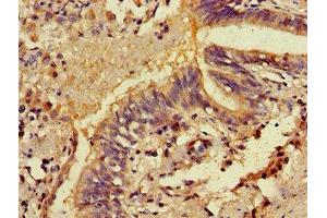 Immunohistochemistry of paraffin-embedded human lung cancer using ABIN7146326 at dilution of 1:100 (EFHA1 抗体  (AA 26-247))