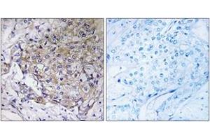 Immunohistochemistry analysis of paraffin-embedded human breast carcinoma tissue, using WASF3 Antibody. (WASF3 抗体  (AA 151-200))