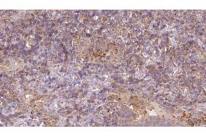 ABIN6273054 at 1/100 staining Human lymph cancer tissue by IHC-P. (MAT1A 抗体  (N-Term))
