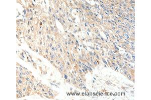 Immunohistochemistry of Human lung cancer using SLC27A1 Polyclonal Antibody at dilution of 1:40 (SLC27A1 抗体)