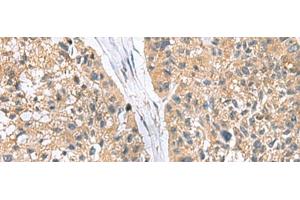 Immunohistochemistry of paraffin-embedded Human esophagus cancer tissue using RGS2 Polyclonal Antibody at dilution of 1:95(x200) (RGS2 抗体)
