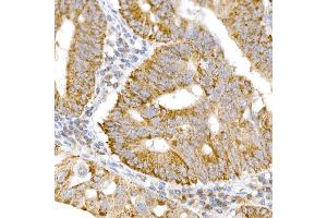 Immunohistochemistry of paraffin-embedded human colon carcinoma using GM130 antibody (ABIN6129789, ABIN6141264, ABIN6141265 and ABIN6220979) at dilution of 1:25 (40x lens). (Golgin A2 (GOLGA2) (AA 20-300) 抗体)