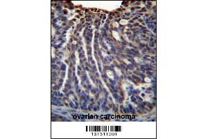 HOXB3 Antibody immunohistochemistry analysis in formalin fixed and paraffin embedded human ovarian carcinoma followed by peroxidase conjugation of the secondary antibody and DAB staining. (HOXB3 抗体  (AA 119-148))