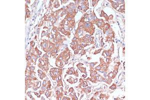Immunohistochemistry of paraffin-embedded human liver cancer using LRP1 antibody (ABIN3021968, ABIN3021969, ABIN3021970 and ABIN6218530) at dilution of 1:100 (40x lens). (LRP1 抗体  (AA 20-270))