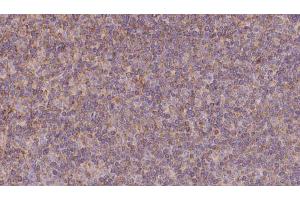 ABIN6273131 at 1/100 staining Human lymph cancer tissue by IHC-P. (KIFC3 抗体  (C-Term))