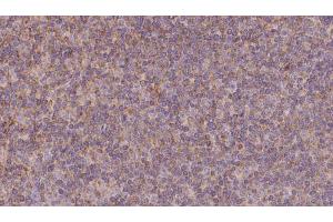 ABIN6273131 at 1/100 staining Human lymph cancer tissue by IHC-P. (KIFC3 抗体  (C-Term))