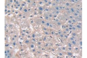 Detection of CD276 in Human Liver cancer Tissue using Polyclonal Antibody to Cluster Of Differentiation 276 (CD276) (CD276 抗体  (AA 47-219))