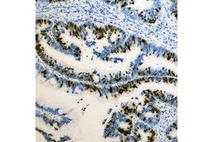 Immunohistochemical analysis of RB1 (pS795) staining in human colon cancer formalin fixed paraffin embedded tissue section.