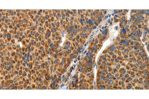 Immunohistochemistry of paraffin-embedded Human liver cancer tissue using ANGPTL1 Polyclonal Antibody at dilution 1:40 (ANGPTL1 抗体)