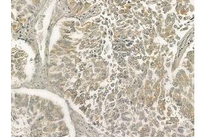 ABIN6263303 and ABIN6273267 at 1/100 staining human lung squamous cell carcinoma by IHC-P.