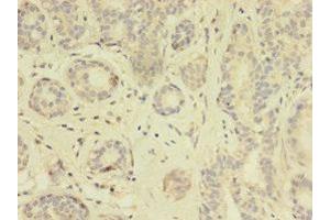 Immunohistochemistry of paraffin-embedded human breast cancer using ABIN7172114 at dilution of 1:100 (TK1 抗体  (AA 2-234))