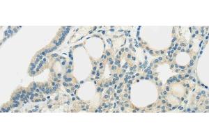 Immunohistochemistry of paraffin-embedded Human thyroid cancer using SLC7A11 Polyclonal Antibody at dilution of 1/35 (SLC7A11 抗体)