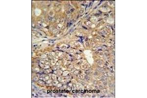 KLHL9 Antibody (Center) (ABIN651366 and ABIN2840204) IHC analysis in formalin fixed and paraffin embedded human prostate carcinoma followed by peroxidase conjugation of the secondary antibody and DAB staining. (KLHL9 抗体  (AA 299-326))