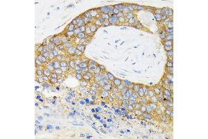 Immunohistochemistry of paraffin-embedded human esophageal cancer using RPS3 Rabbit pAb (ABIN3023342, ABIN3023343, ABIN3023344 and ABIN6219623) at dilution of 1:100 (40x lens). (RPS3 抗体  (AA 1-243))