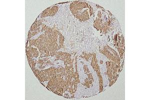 human head and neck squamous-cell carcinoma (HNSCC)(courtesy of J.