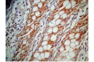 Human colon cancer tissue was stained by Rabbit Anti-GLP-1 (12-24) (Human) Antibody (GLP-1 抗体  (AA 12-24))