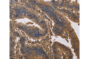 Immunohistochemistry of Human liver cancer using KCNG1 Polyclonal Antibody at dilution of 1:40 (KCNG1 抗体)