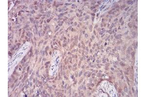 Immunohistochemical analysis of paraffin-embedded cervical cancer tissues using PLCG1 mouse mAb with DAB staining.