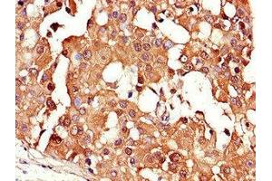 Immunohistochemistry of paraffin-embedded human breast cancer using ABIN7147342 at dilution of 1:100 (CRABP2 抗体  (AA 1-138))