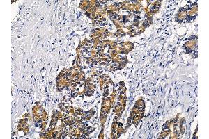 ABIN6258567 and ABIN6276236 at 1/100 staining human colorectal cancer by IHC-P. (VN1R2 抗体  (Internal Region))