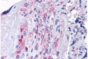 Human Placenta (formalin-fixed, paraffin-embedded) stained with ADAMTS5 antibody ABIN625839 at 14 ug/ml followed by biotinylated goat anti-rabbit IgG secondary antibody ABIN481713, alkaline phosphatase-streptavidin and chromogen. (ADAMTS5 抗体  (N-Term))