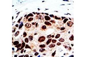 IHC analysis of FFPE human breast cancer tissue stained with the HDAC9 antibody (HDAC9 抗体  (AA 503-533))