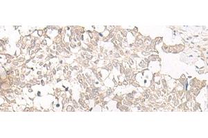 Immunohistochemistry of paraffin-embedded Human lung cancer tissue using ESPN Polyclonal Antibody at dilution of 1:25(x200) (Espin 抗体)