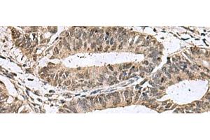Immunohistochemistry of paraffin-embedded Human colorectal cancer tissue using TMX3 Polyclonal Antibody at dilution of 1:70(x200)