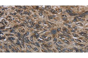 Immunohistochemistry of paraffin-embedded Human esophagus cancer tissue using CD236 Polyclonal Antibody at dilution 1:60 (CD236/GYPC 抗体)