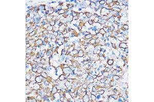 Immunohistochemistry of paraffin-embedded Human esophageal cancer using Cytokeratin 5 (Cytokeratin 5 (KRT5)) Rabbit pAb (ABIN3016404, ABIN3016405, ABIN3016406 and ABIN6219743) at dilution of 1:100 (40x lens). (Cytokeratin 5 抗体)