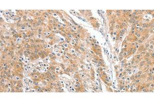 Immunohistochemistry of paraffin-embedded Human gastric cancer using COL4A3BP Polyclonal Antibody at dilution of 1:60 (COL4A3BP 抗体)