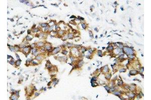Anti-Superoxide Dismutase 1 antibody, IHC(P) IHC(P): Human Mammary Cancer Tissue (SOD1 抗体  (C-Term))